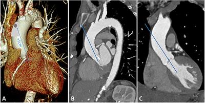 Minireview: Transaortic Transcatheter Aortic Valve Implantation: Is There Still an Indication?